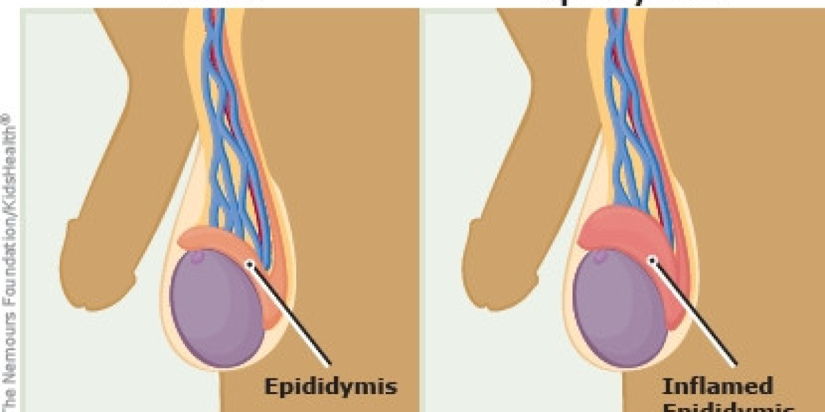 Understanding Epididymitis: Causes, Symptoms, and Effective Treatments